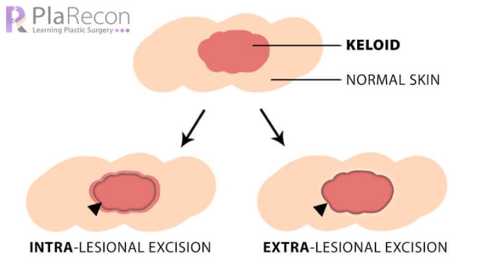 Keloid Management: Prevention and Treatment